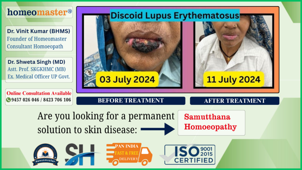 Case Study: Discoid Lupus Erythematous